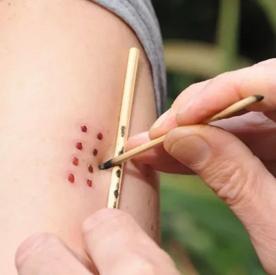 Kambo application - Médecine purificatrice amazonienne